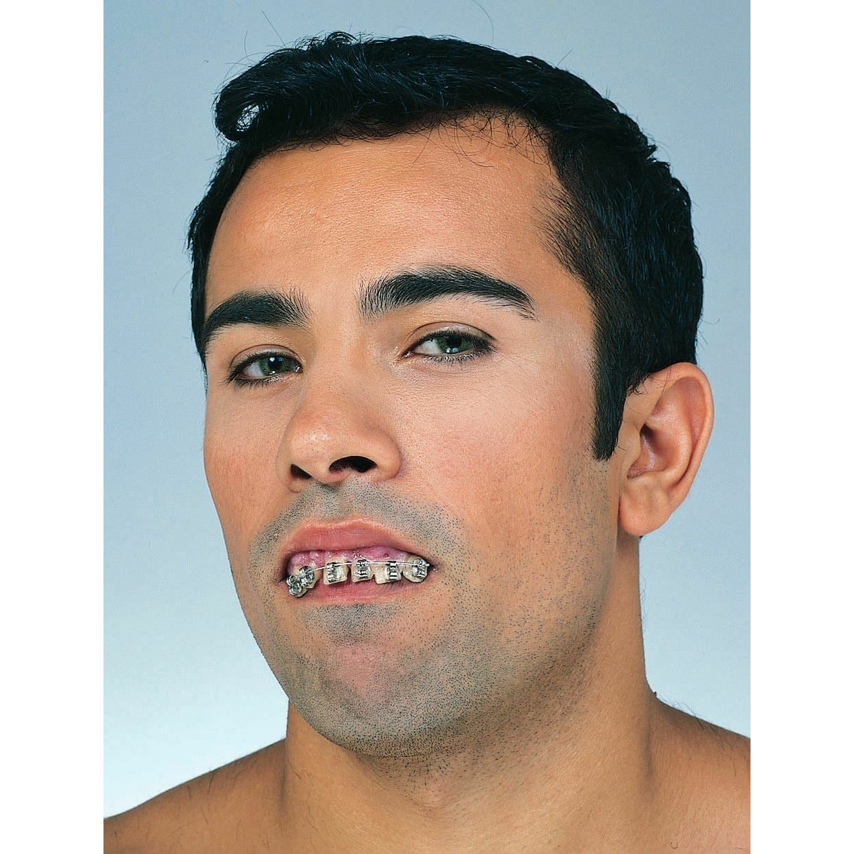 Braces teeth putty